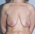 Patient # 56755 Before Photo # 1